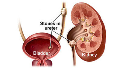 Excretory System Disorders And Diseases